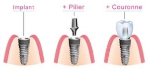 Etape de l'implantologie dentaire